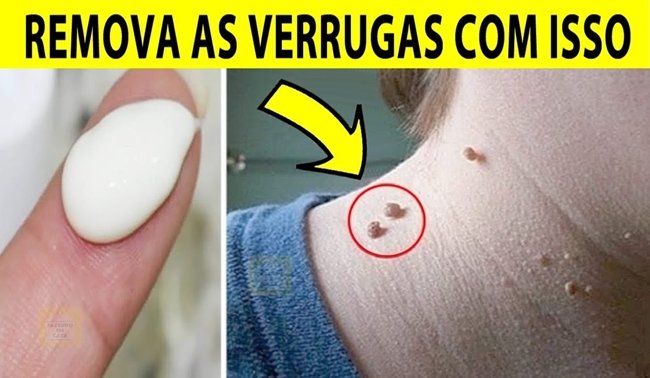 Como tirar verrugas em casa