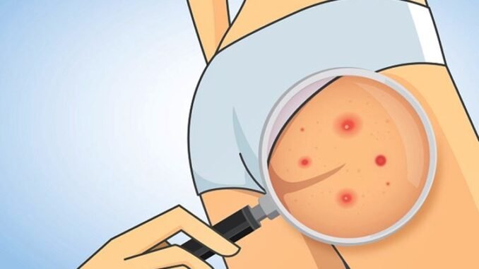 Passe Isso Para Eliminar as Espinhas e Caroços no Bumbum